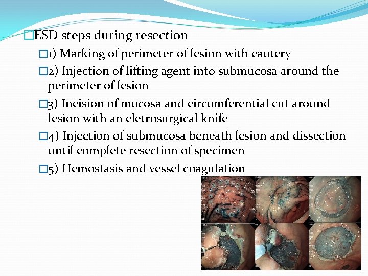 �ESD steps during resection � 1) Marking of perimeter of lesion with cautery �