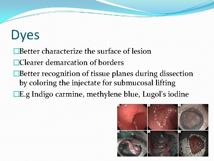 Dyes �Better characterize the surface of lesion �Clearer demarcation of borders �Better recognition of