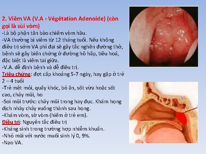 2. Viêm VA (V. A - Végétation Adenoide) (còn gọi là sùi vòm) -Là