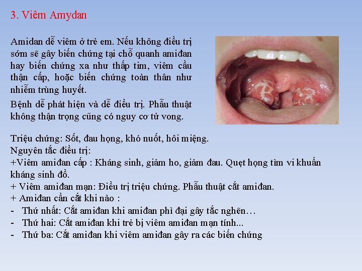 3. Viêm Amydan Amidan dễ viêm ở trẻ em. Nếu không điều trị sớm
