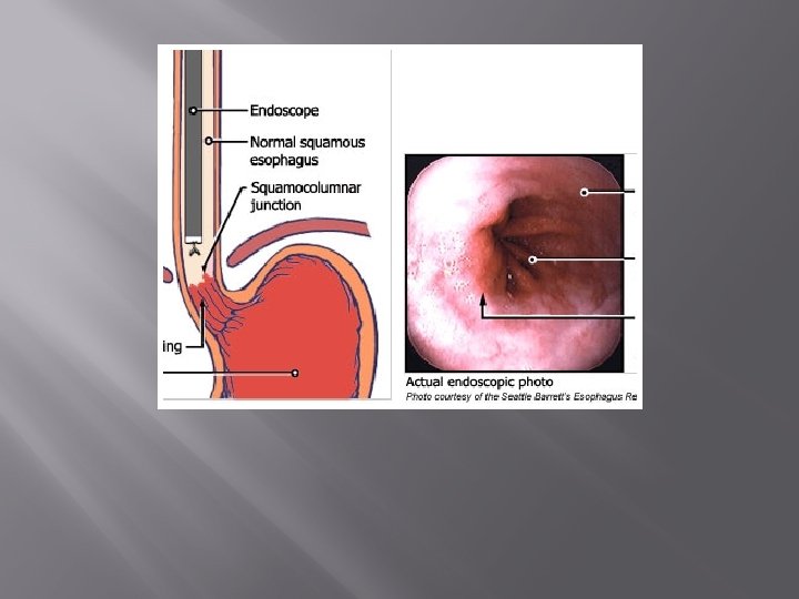 Figure 3: OGD of esophagus and cardia 