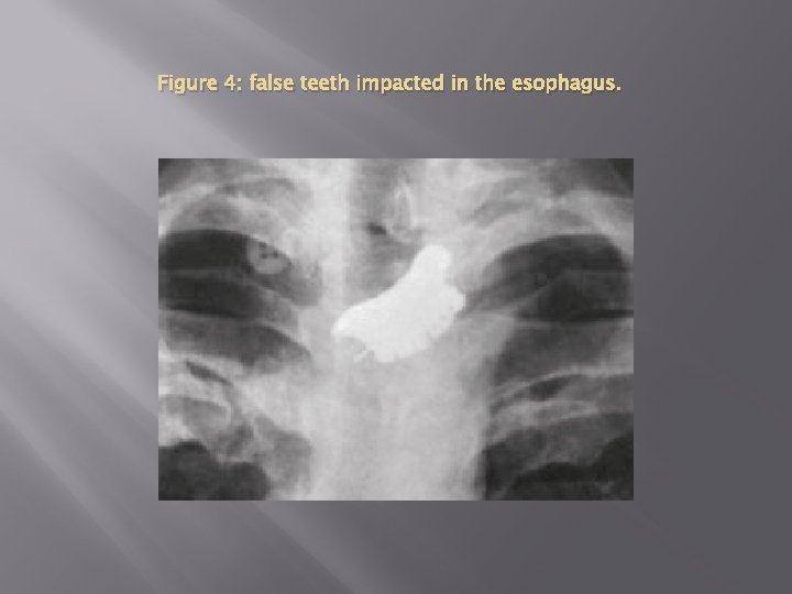 Figure 4: false teeth impacted in the esophagus. 