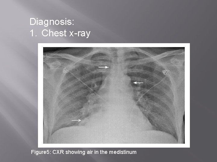 Diagnosis: 1. Chest x-ray Figure 5: CXR showing air in the medistinum 