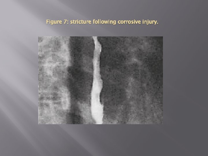 Figure 7: stricture following corrosive injury. 