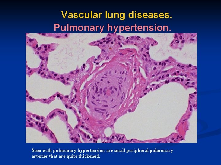 Vascular lung diseases. Pulmonary hypertension. Seen with pulmonary hypertension are small peripheral pulmonary arteries