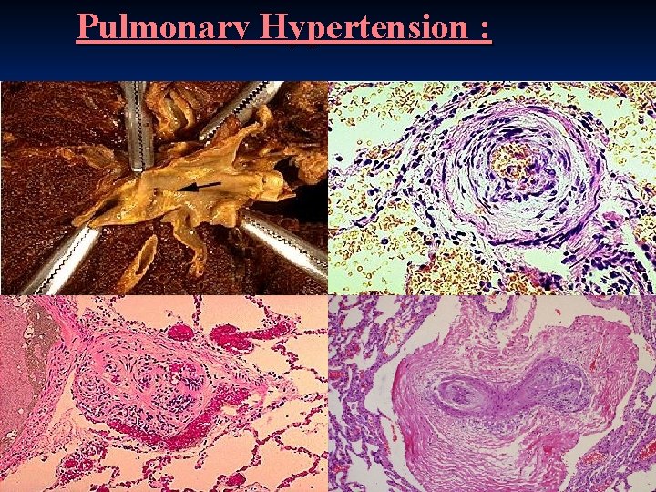Pulmonary Hypertension : 