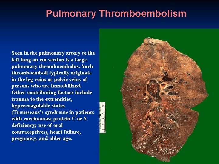 Pulmonary Thromboembolism Seen in the pulmonary artery to the left lung on cut section