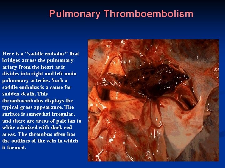 Pulmonary Thromboembolism Here is a "saddle embolus" that bridges across the pulmonary artery from