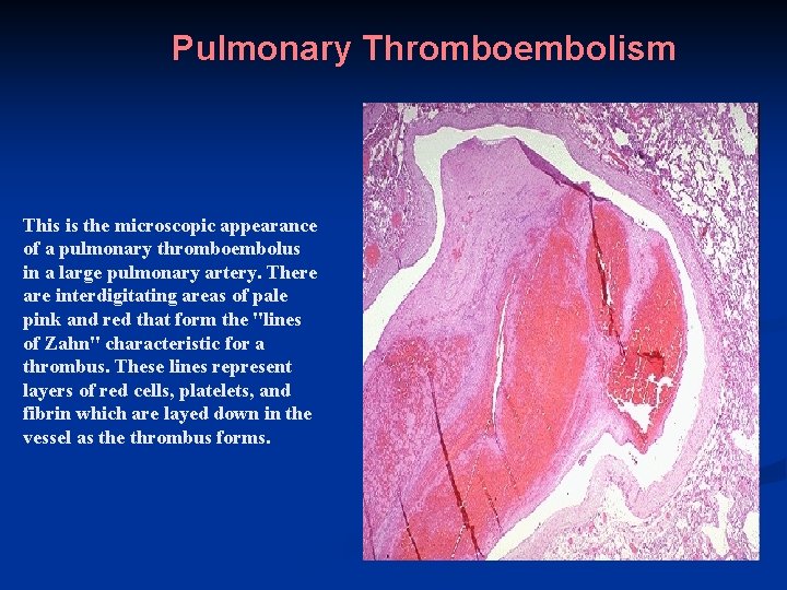 Pulmonary Thromboembolism This is the microscopic appearance of a pulmonary thromboembolus in a large
