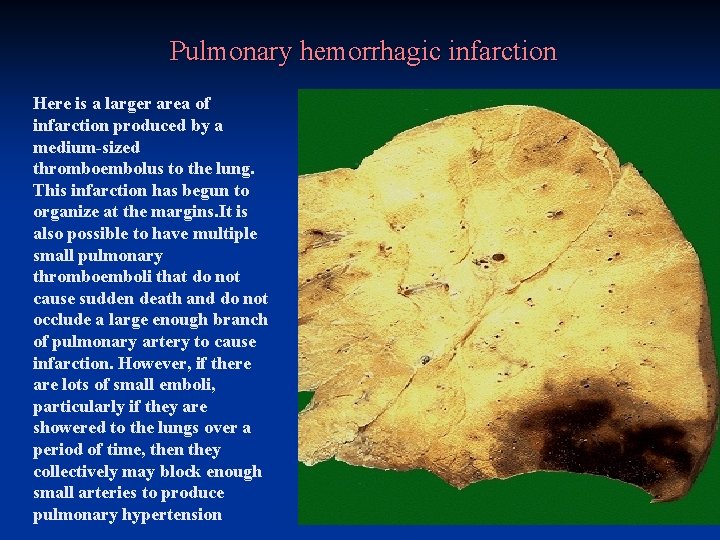 VASCULAR LUNG DISEASES PULMONARY HYPERTENSION Thromboembolism