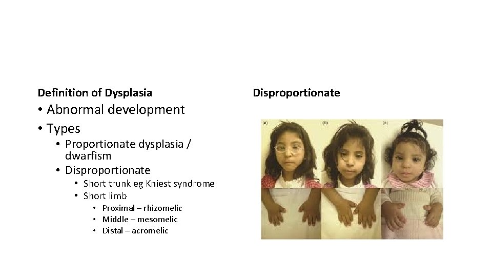 Definition of Dysplasia • Abnormal development • Types • Proportionate dysplasia / dwarfism •