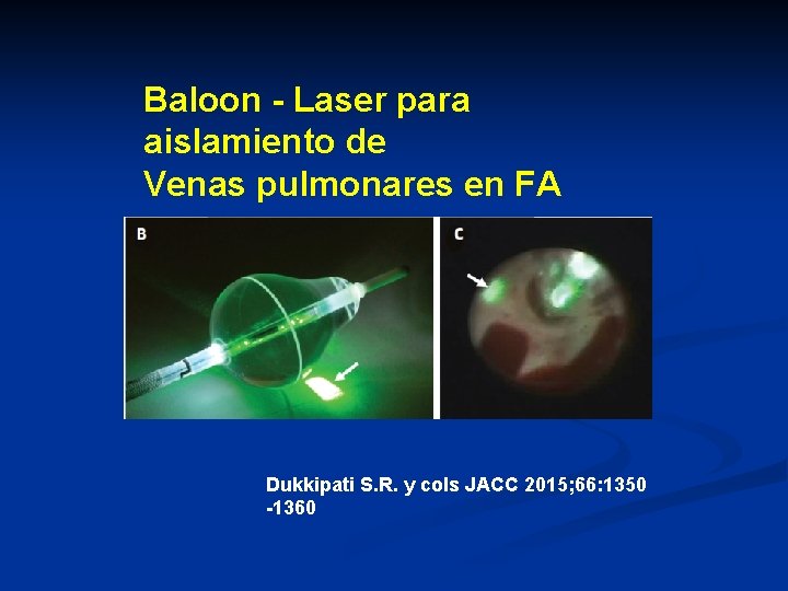 Baloon - Laser para aislamiento de Venas pulmonares en FA Dukkipati S. R. y Baloon - Laser para aislamiento de Venas pulmonares en FA Dukkipati S. R. y