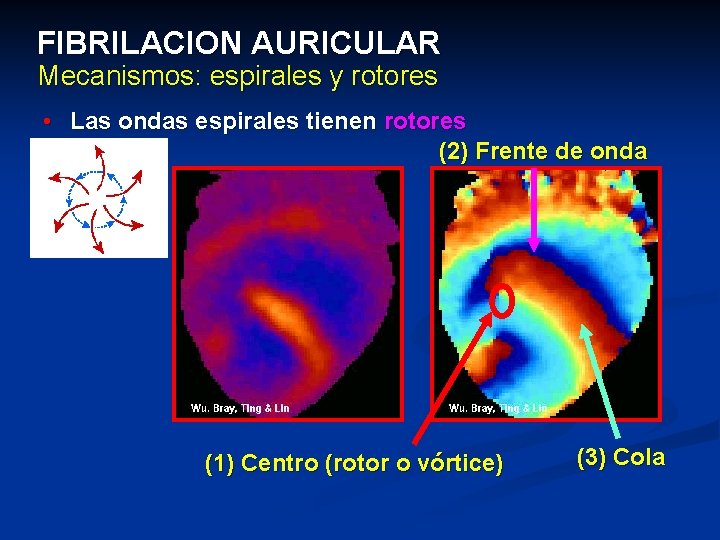 FIBRILACION AURICULAR Mecanismos: espirales y rotores • Las ondas espirales tienen rotores (2) Frente FIBRILACION AURICULAR Mecanismos: espirales y rotores • Las ondas espirales tienen rotores (2) Frente