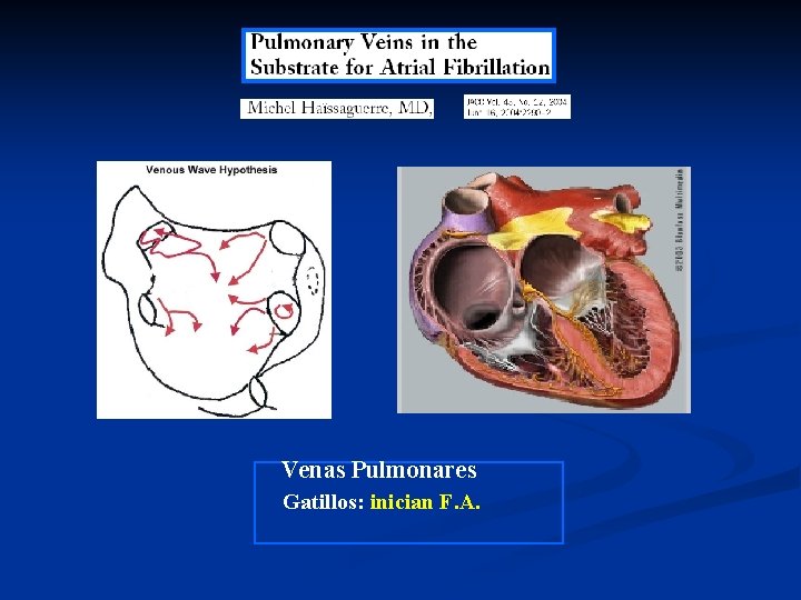 Venas Pulmonares Gatillos: inician F. A. Venas Pulmonares Gatillos: inician F. A.
