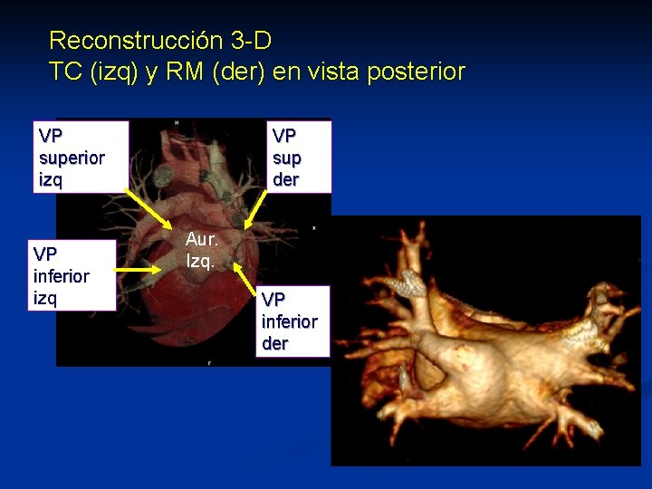 Reconstrucción 3 -D TC (izq) y RM (der) en vista posterior VP superior izq Reconstrucción 3 -D TC (izq) y RM (der) en vista posterior VP superior izq