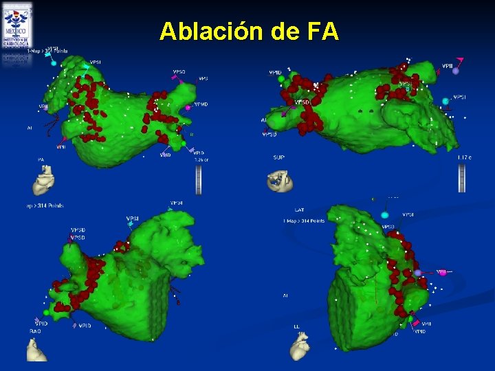 Ablación de FA Ablación de FA