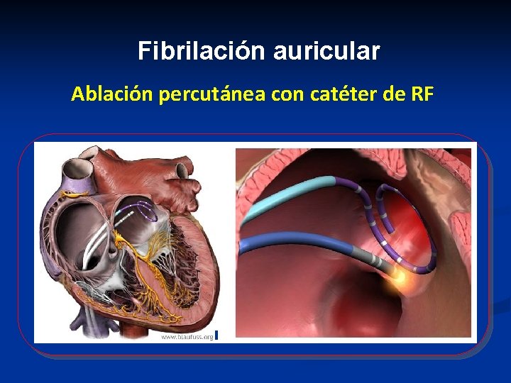 Fibrilación auricular Ablación percutánea con catéter de RF Fibrilación auricular Ablación percutánea con catéter de RF