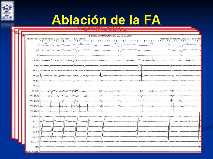 Ablación de la FA Ablación de la FA