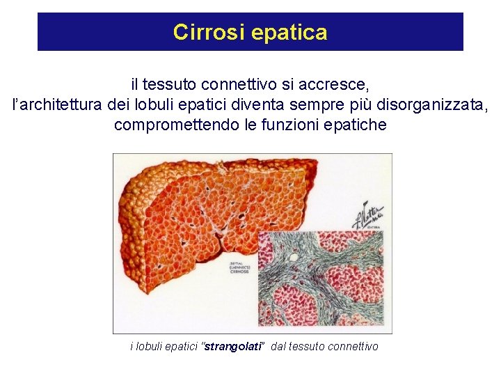 Cirrosi epatica il tessuto connettivo si accresce, l’architettura dei lobuli epatici diventa sempre più