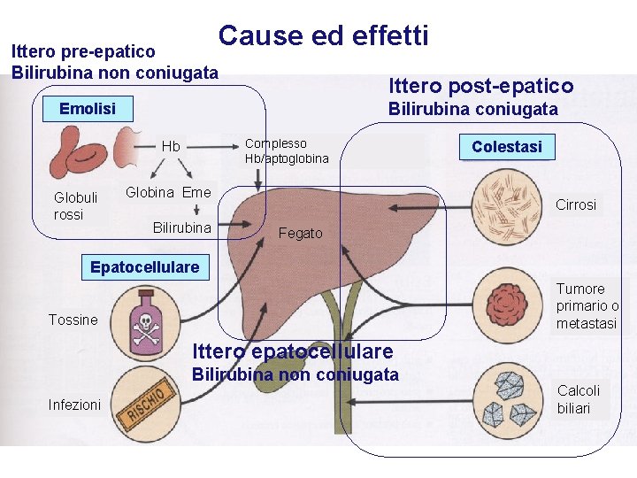 Cause ed effetti Ittero pre-epatico Bilirubina non coniugata Ittero post-epatico Bilirubina coniugata Emolisi Complesso