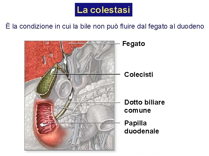 La colestasi È la condizione in cui la bile non può fluire dal fegato