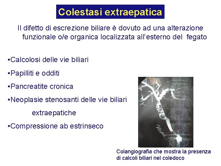 Colestasi extraepatica Il difetto di escrezione biliare è dovuto ad una alterazione funzionale o/e