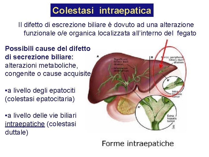 Colestasi intraepatica Il difetto di escrezione biliare è dovuto ad una alterazione funzionale o/e