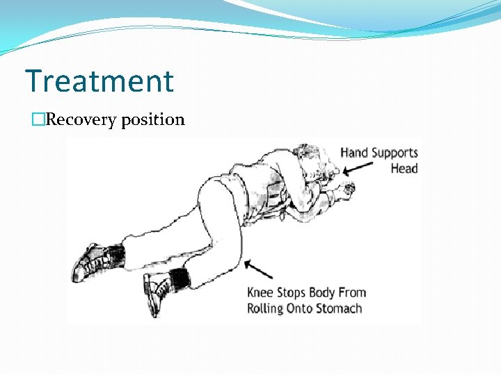 Treatment �Recovery position 