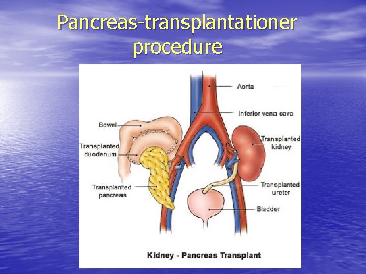 Pancreas-transplantationer procedure 
