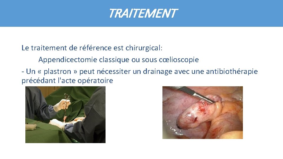 TRAITEMENT Le traitement de référence est chirurgical: Appendicectomie classique ou sous cœlioscopie - Un