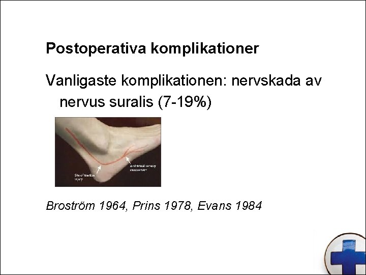 Postoperativa komplikationer Vanligaste komplikationen: nervskada av nervus suralis (7 -19%) Broström 1964, Prins 1978,