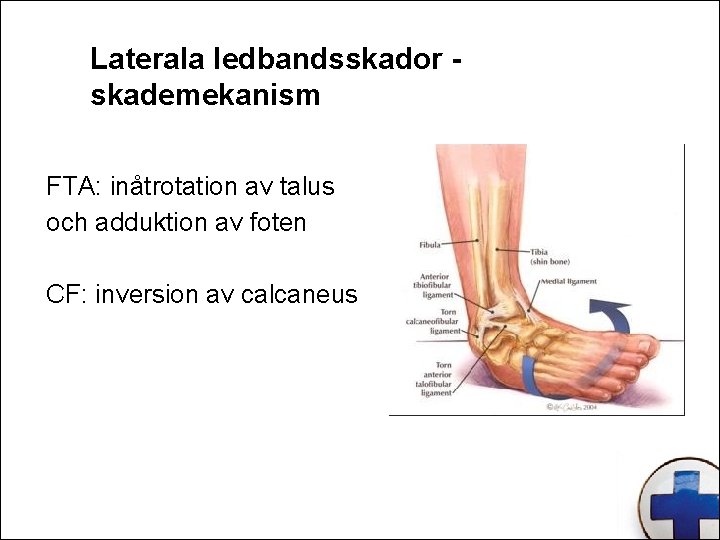 Laterala ledbandsskador skademekanism FTA: inåtrotation av talus och adduktion av foten CF: inversion av