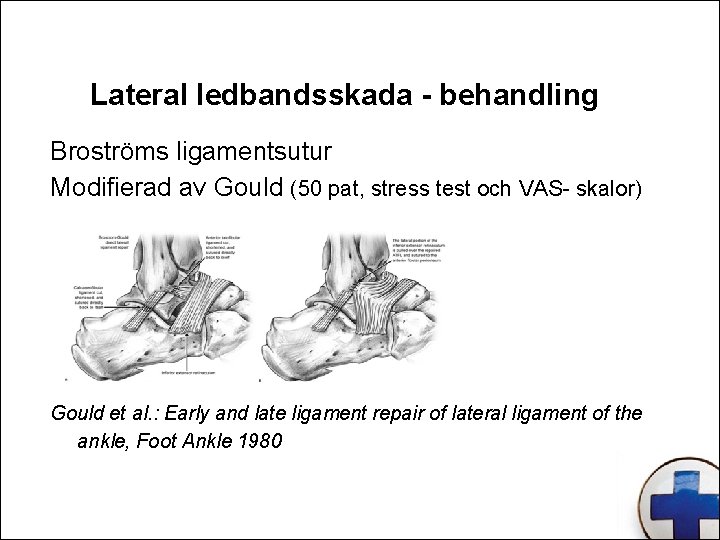 Lateral ledbandsskada - behandling Broströms ligamentsutur Modifierad av Gould (50 pat, stress test och