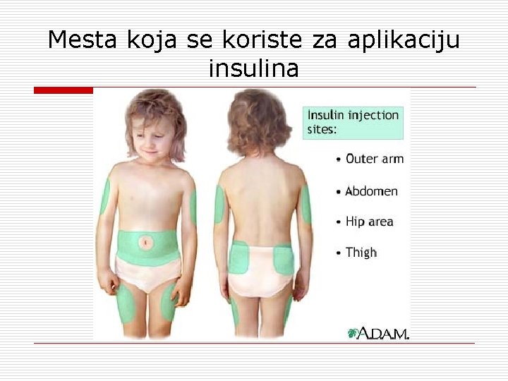 Mesta koja se koriste za aplikaciju insulina 