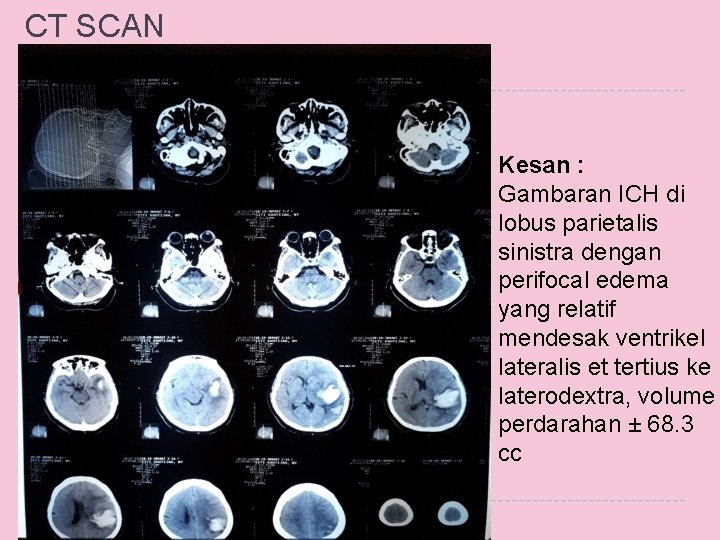 CT SCAN Kesan : Gambaran ICH di lobus parietalis sinistra dengan perifocal edema yang