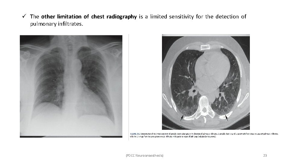 ü The other limitation of chest radiography is a limited sensitivity for the detection