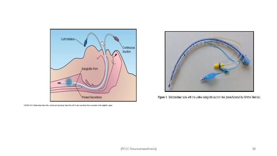 (PDCC Neuroanaesthesia) 36 