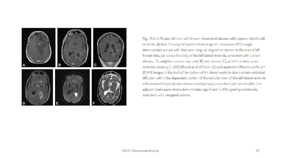 (PDCC Neuroanaesthesia) 57 