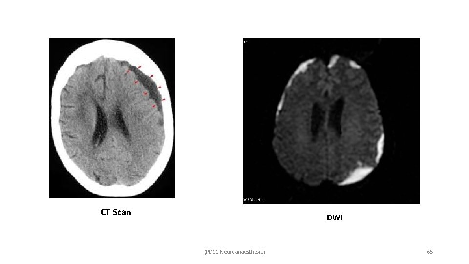CT Scan DWI (PDCC Neuroanaesthesia) 65 