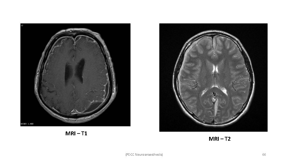 MRI – T 1 MRI – T 2 (PDCC Neuroanaesthesia) 66 