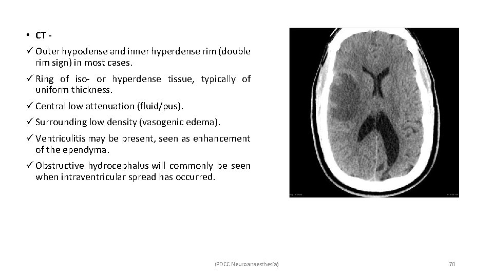  • CT ü Outer hypodense and inner hyperdense rim (double rim sign) in