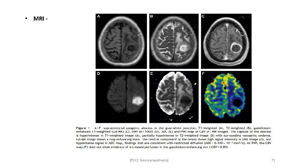  • MRI - (PDCC Neuroanaesthesia) 71 