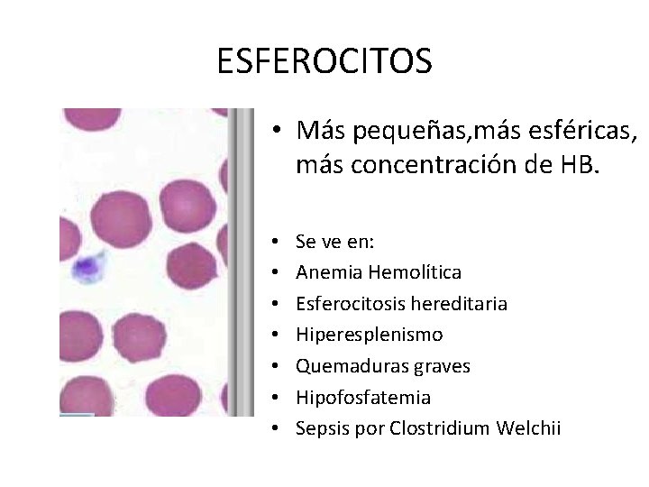 ESFEROCITOS • Más pequeñas, más esféricas, más concentración de HB. • • Se ve