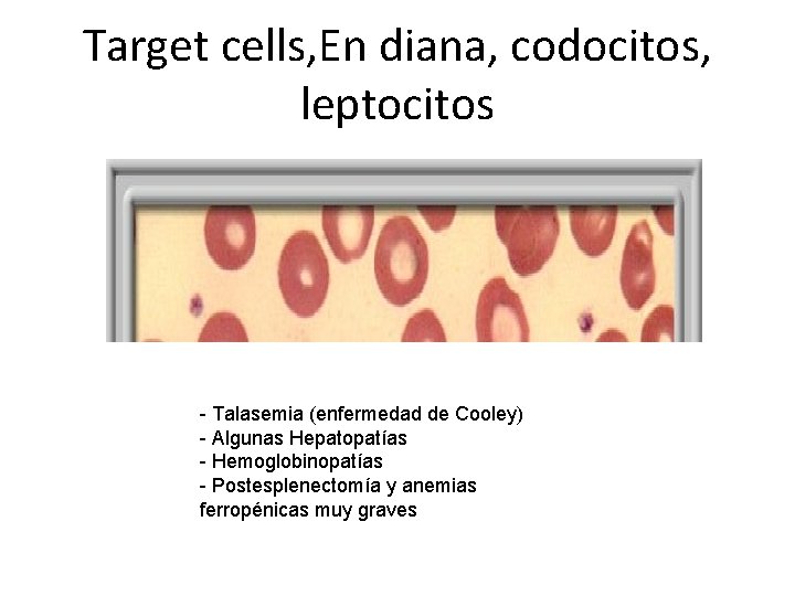 Target cells, En diana, codocitos, leptocitos - Talasemia (enfermedad de Cooley) - Algunas Hepatopatías