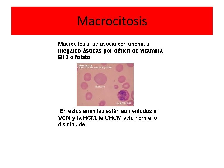 Macrocitosis se asocia con anemias megaloblásticas por déficit de vitamina B 12 o folato.