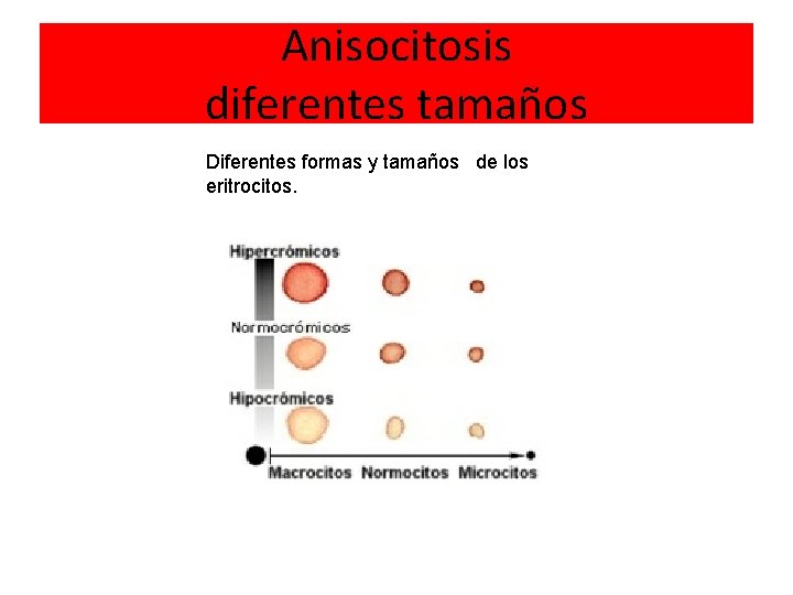 Anisocitosis diferentes tamaños Diferentes formas y tamaños de los eritrocitos. 