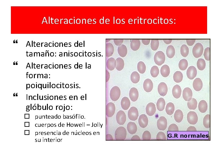 Alteraciones de los eritrocitos: Alteraciones del tamaño: anisocitosis. Alteraciones de la forma: poiquilocitosis. Inclusiones