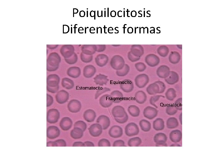 Poiquilocitosis Diferentes formas 