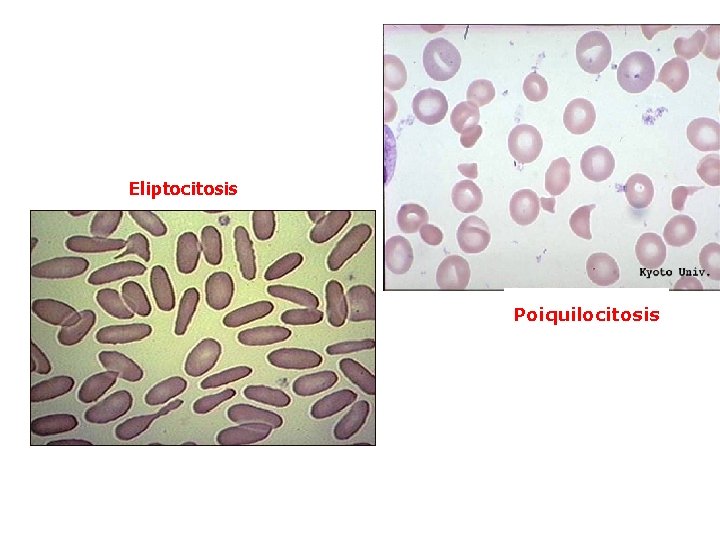 Eliptocitosis Poiquilocitosis 