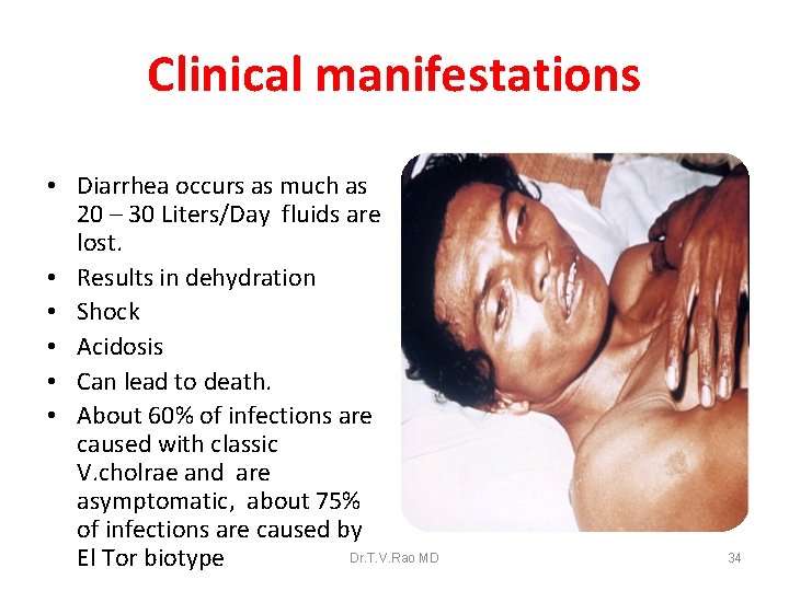 Clinical manifestations • Diarrhea occurs as much as 20 – 30 Liters/Day fluids are